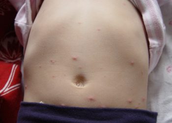 Bahia registra 443 casos de catapora até a Semana Epidemiológica 32