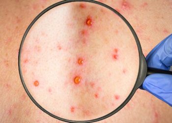 Sesab emite alerta após surtos de catapora na Bahia