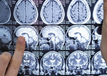 AVC: Acidente Vascular Cerebral causou quase 89 mil mortes no país em 2023