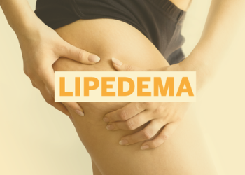 Lipedema: mais de 10 milhões de brasileiras podem ter a doença e não sabem