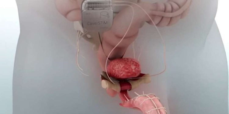 Com ‘viagra eletrônico’, brasileiro quer revolucionar tratamento de disfunção