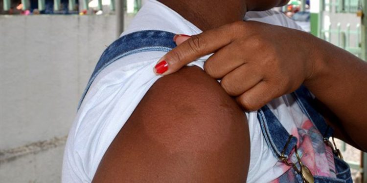 Janeiro Roxo: Hanseníase pode causar manchas e perda de sensibilidade