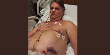 Bolsonaro segue em recuperação na UTI após cirurgia no intestino