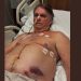 Bolsonaro segue em recuperação na UTI após cirurgia no intestino