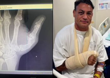 Popó recebe alta após cirurgia e tranquiliza fãs: “Deu tudo certo, estamos bem”