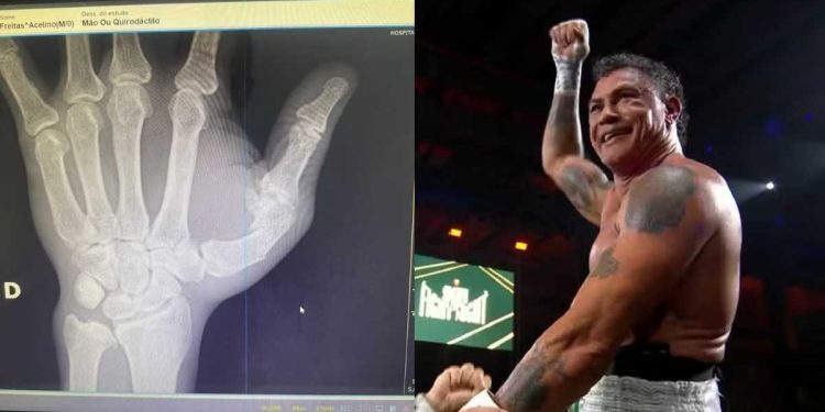 Popó passa por cirurgia em Salvador após lesão na mão durante briga no Spaten Fight Night