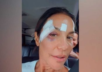 Ivete Sangalo recebe alta após desmaio, brinca com machucados no rosto e revela diagnóstico médico