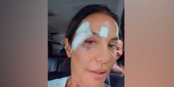 Ivete Sangalo recebe alta após desmaio, brinca com machucados no rosto e revela diagnóstico médico