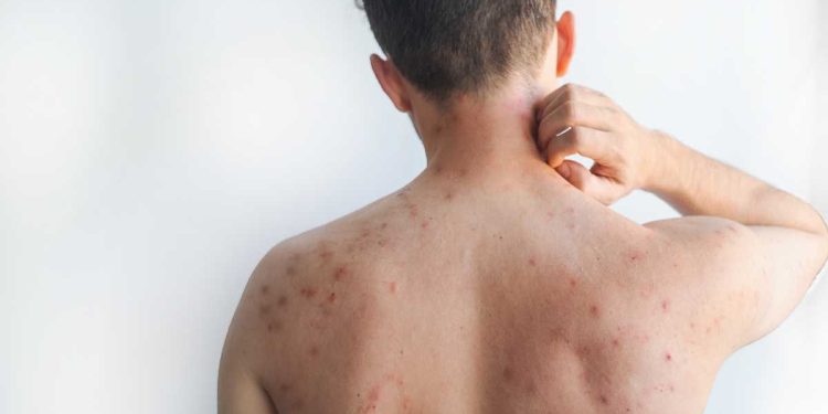 Bahia reforça vigilância contra sarampo e rubéola com Dia “S” de Busca Ativa