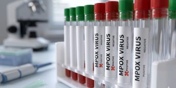Brasil registra 140 casos confirmados de Mpox em 2026
